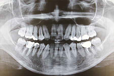 レントゲン検査