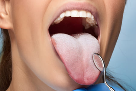 舌クリーニング