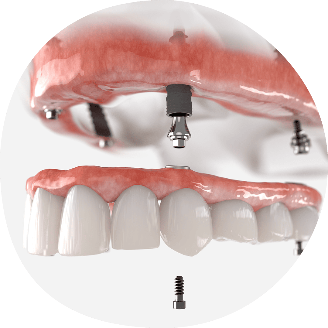 インプラント・メインテナンス