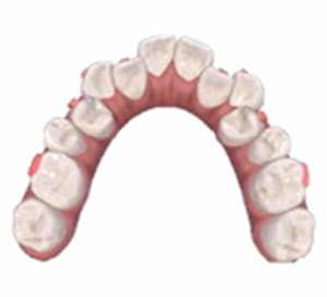 治療前の歯並び