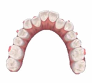 治療中の歯並び