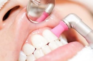 歯面一次研磨（PMTC）